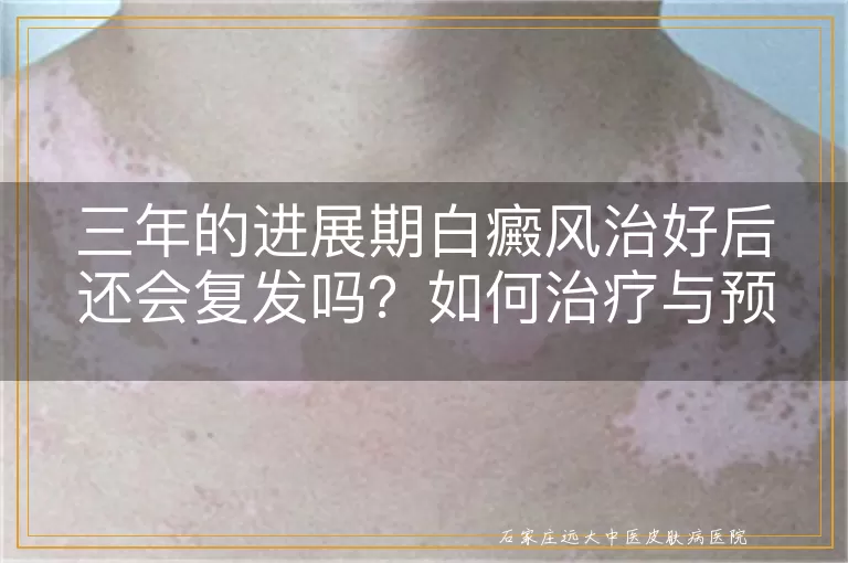 三年的进展期白癜风治好后还会复发吗？如何治疗与预防