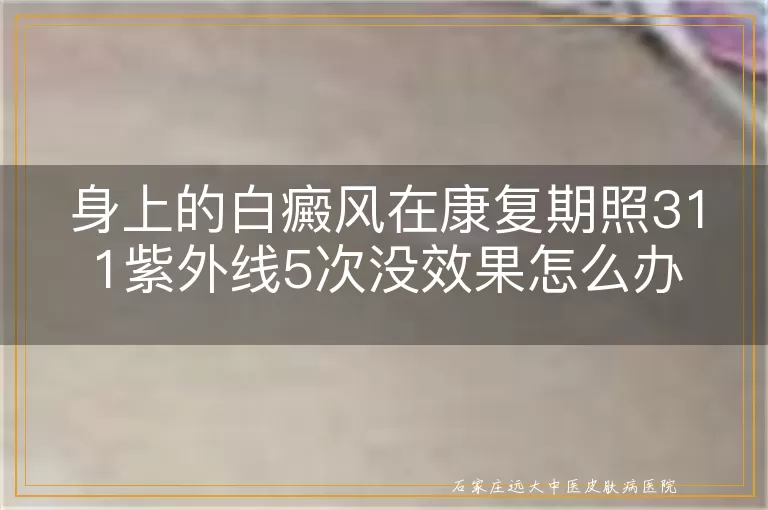 身上的白癜风在康复期照311紫外线5次没效果怎么办