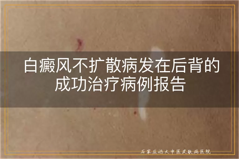 白癜风不扩散病发在后背的成功治疗病例报告