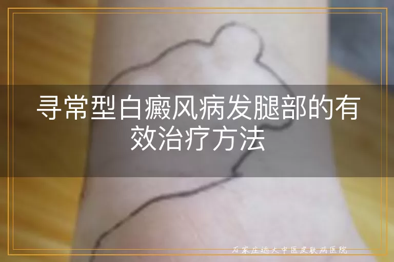寻常型白癜风病发腿部的有效治疗方法