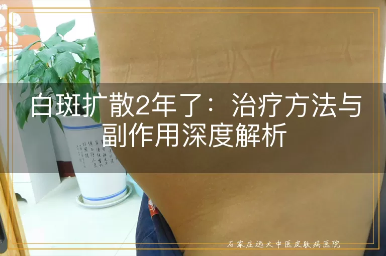 白斑扩散2年了：治疗方法与副作用深度解析