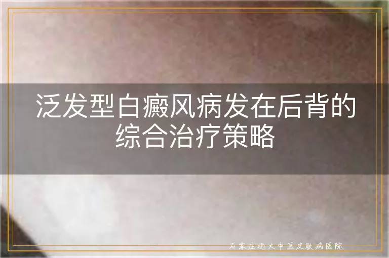 泛发型白癜风病发在后背的综合治疗策略