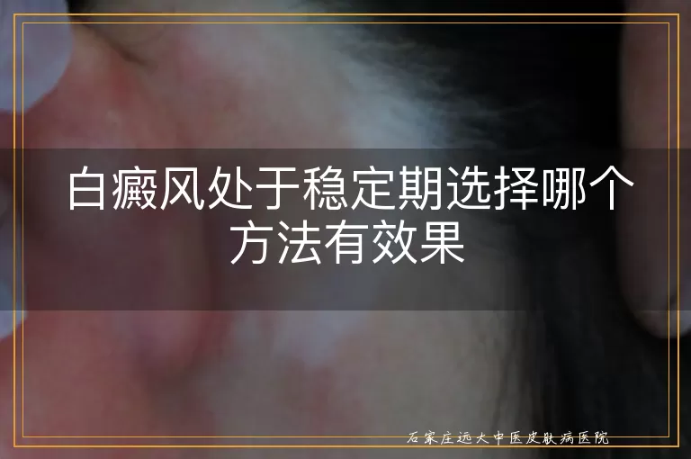 白癜风处于稳定期选择哪个方法有效果