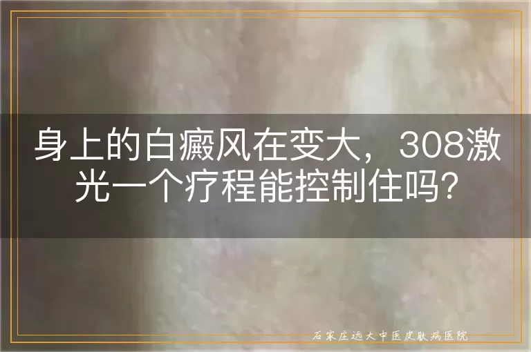 身上的白癜风在变大，308激光一个疗程能控制住吗？