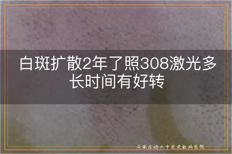 白斑扩散2年了照308激光多长时间有好转