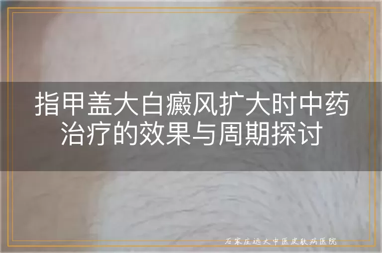 指甲盖大白癜风扩大时中药治疗的效果与周期探讨