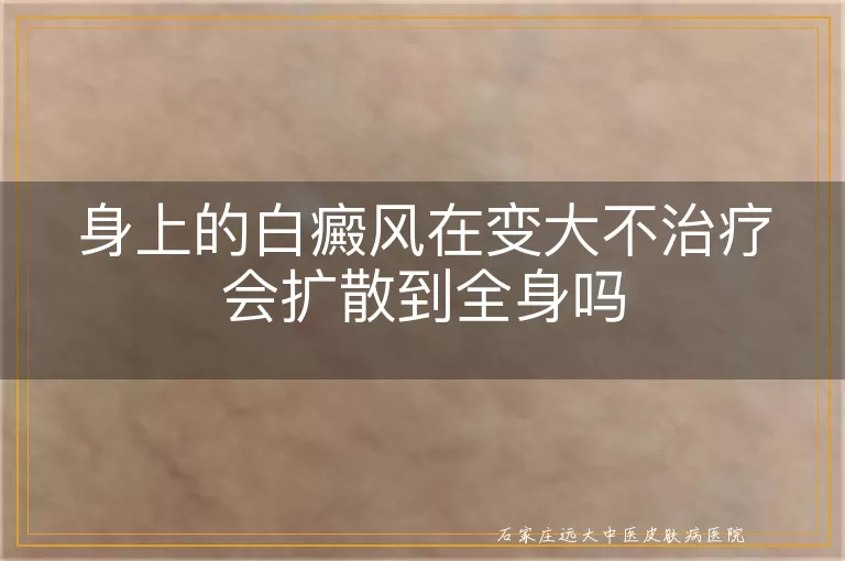身上的白癜风在变大不治疗会扩散到全身吗