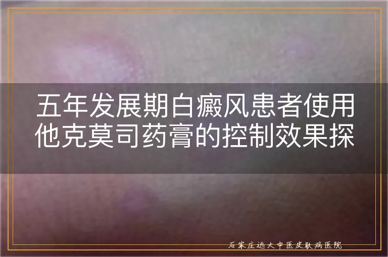 五年发展期白癜风患者使用他克莫司药膏的控制效果探讨