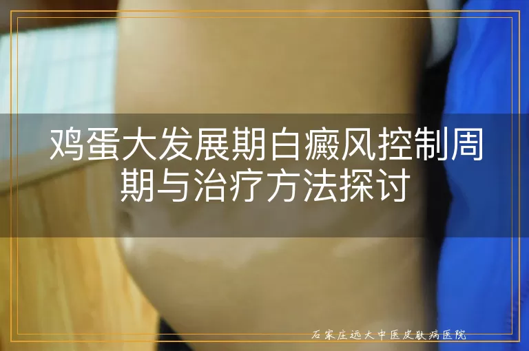 鸡蛋大发展期白癜风控制周期与治疗方法探讨