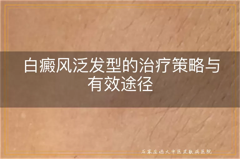 白癜风泛发型的治疗策略与有效途径
