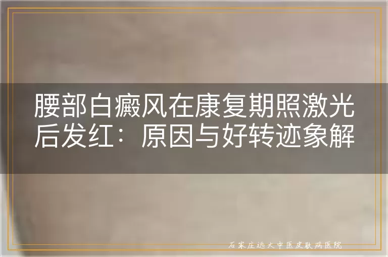 腰部白癜风在康复期照激光后发红：原因与好转迹象解析