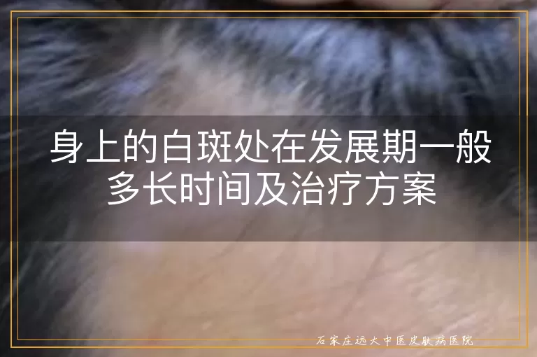 身上的白斑处在发展期一般多长时间及治疗方案