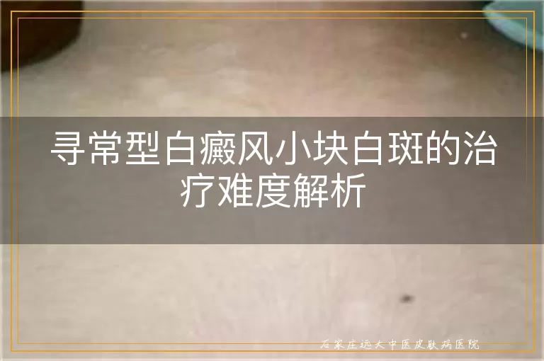 寻常型白癜风小块白斑的治疗难度解析