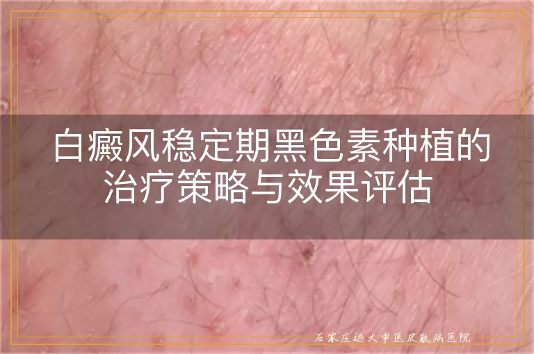 白癜风稳定期黑色素种植的治疗策略与效果评估