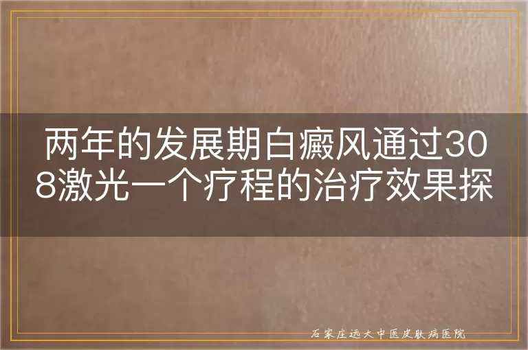 两年的发展期白癜风通过308激光一个疗程的治疗效果探讨