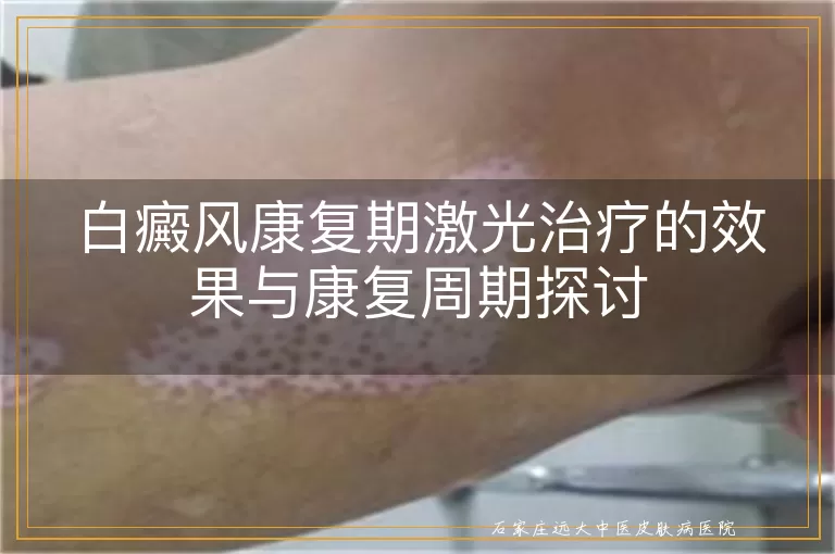 白癜风康复期激光治疗的效果与康复周期探讨