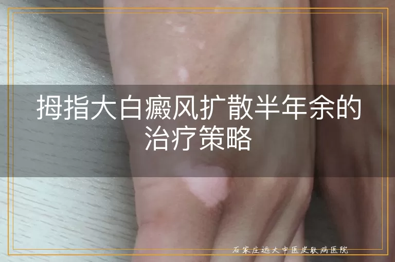 拇指大白癜风扩散半年余的治疗策略