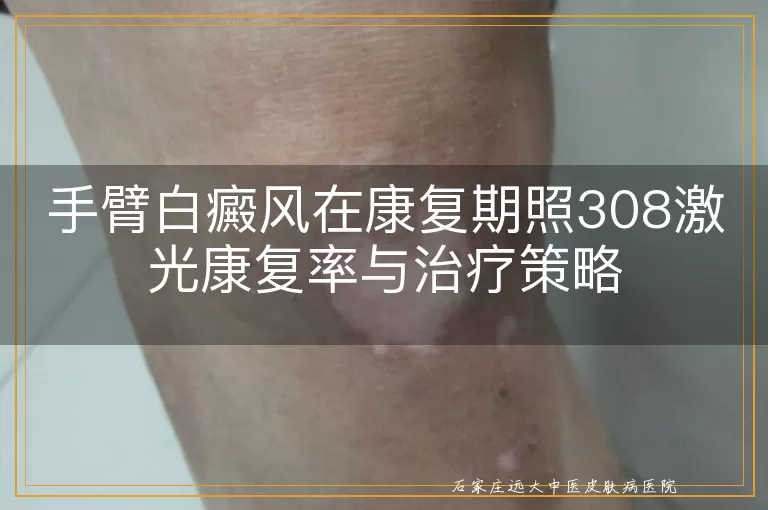 手臂白癜风在康复期照308激光康复率与治疗策略