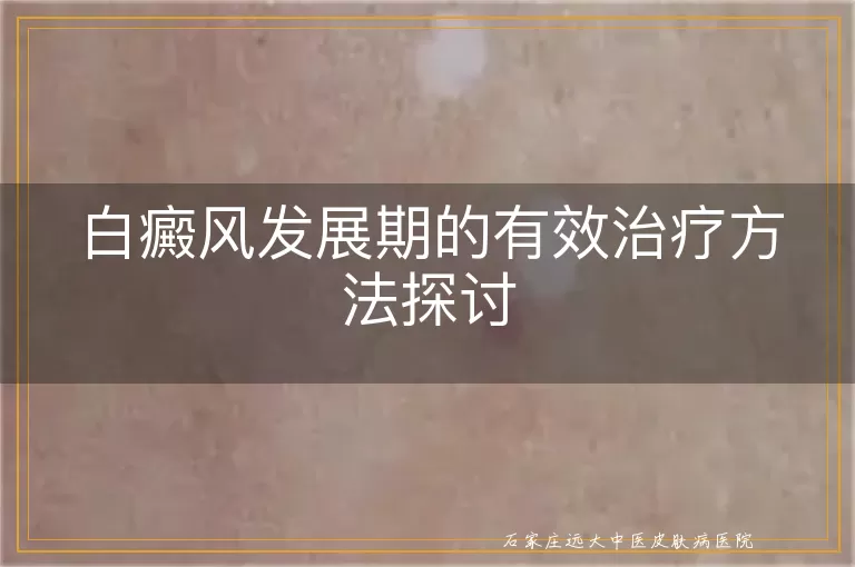 白癜风发展期的有效治疗方法探讨