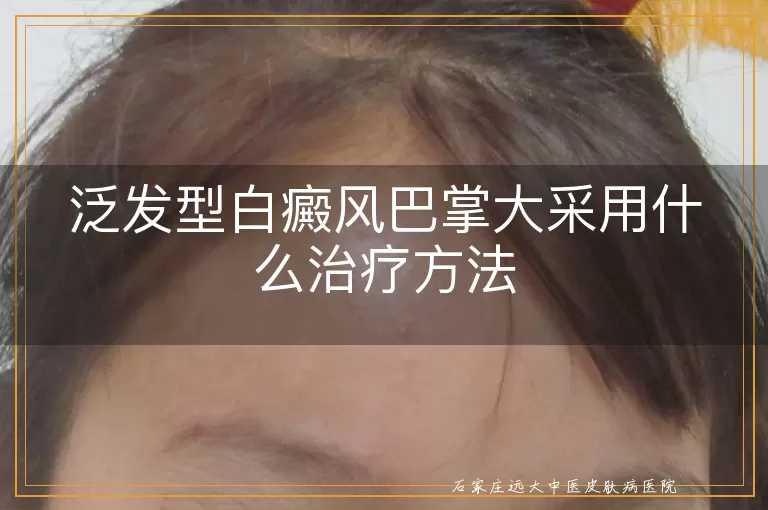 泛发型白癜风巴掌大采用什么治疗方法