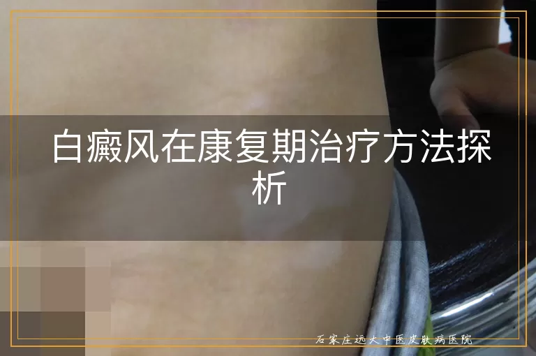 白癜风在康复期治疗方法探析