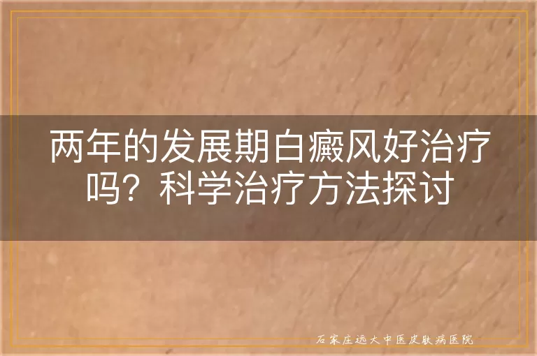 两年的发展期白癜风好治疗吗？科学治疗方法探讨