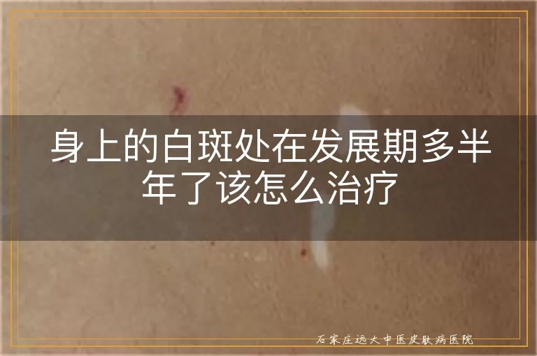 身上的白斑处在发展期多半年了该怎么治疗