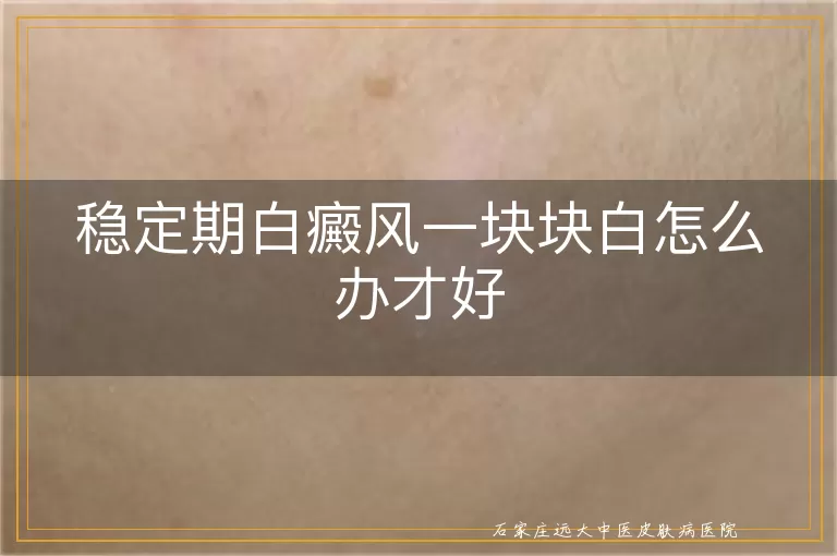 稳定期白癜风一块块白怎么办才好