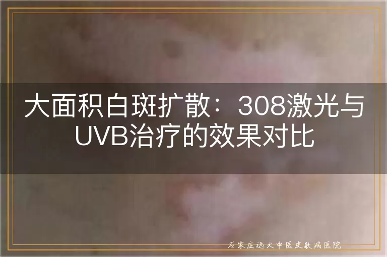 大面积白斑扩散：308激光与UVB治疗的效果对比