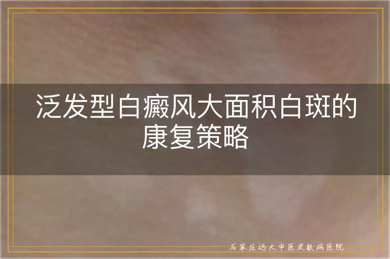 泛发型白癜风大面积白斑的康复策略
