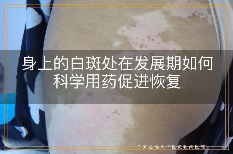 身上的白斑处在发展期如何科学用药促进恢复