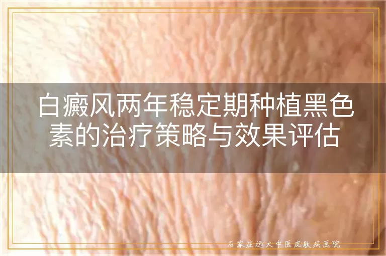 白癜风两年稳定期种植黑色素的治疗策略与效果评估