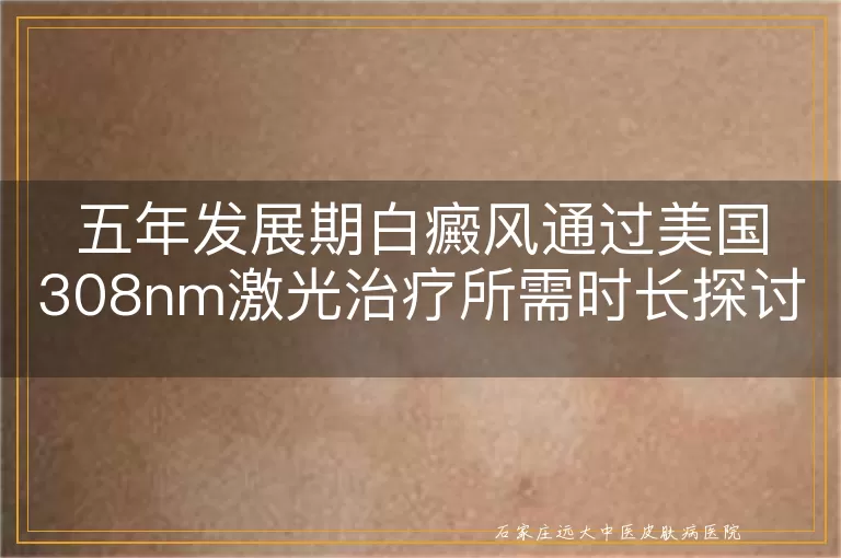 五年发展期白癜风通过美国308nm激光治疗所需时长探讨