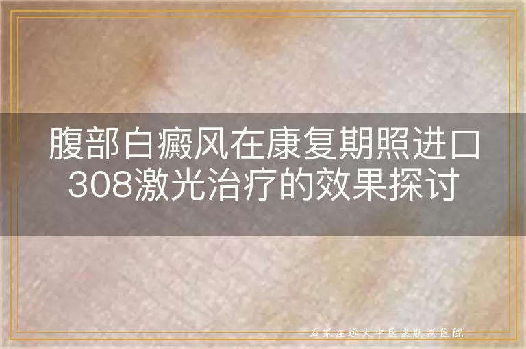 腹部白癜风在康复期照进口308激光治疗的效果探讨