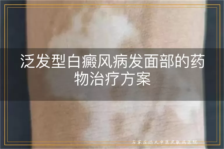 泛发型白癜风病发面部的药物治疗方案