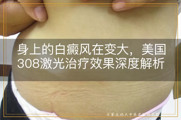 身上的白癜风在变大，美国308激光治疗效果深度解析