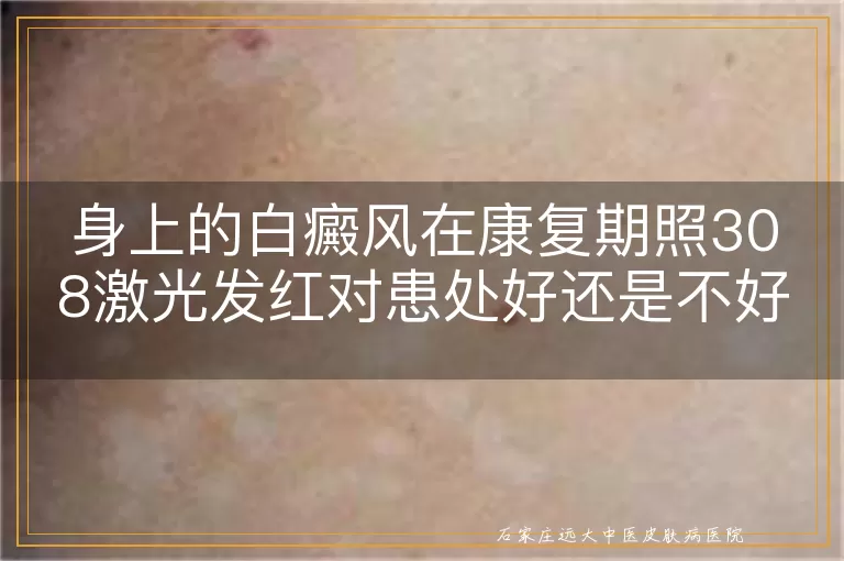 身上的白癜风在康复期照308激光发红对患处好还是不好