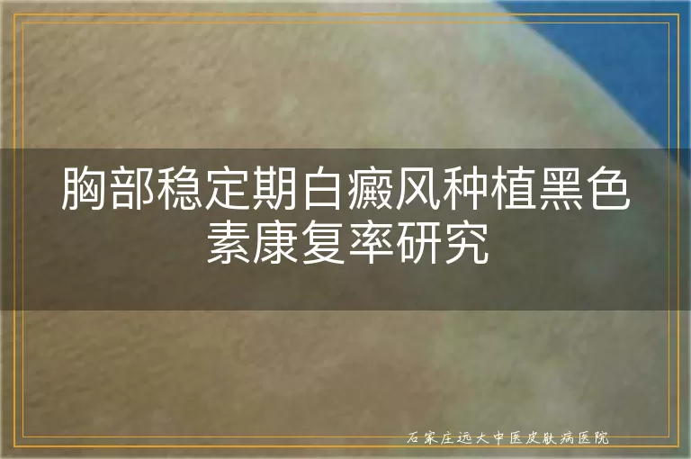 胸部稳定期白癜风种植黑色素康复率研究