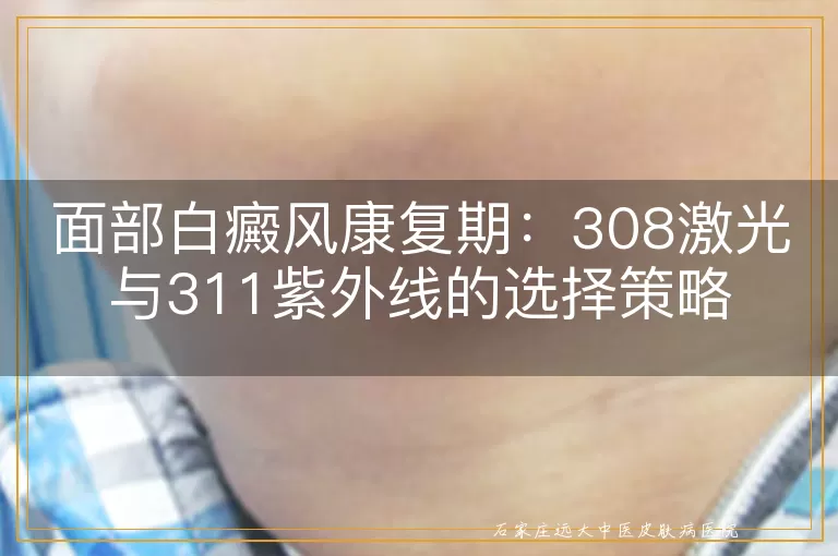 面部白癜风康复期：308激光与311紫外线的选择策略