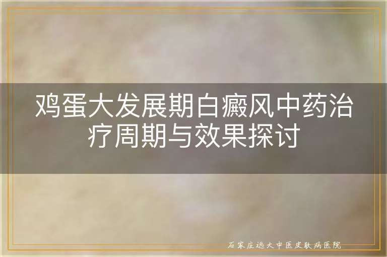 鸡蛋大发展期白癜风中药治疗周期与效果探讨
