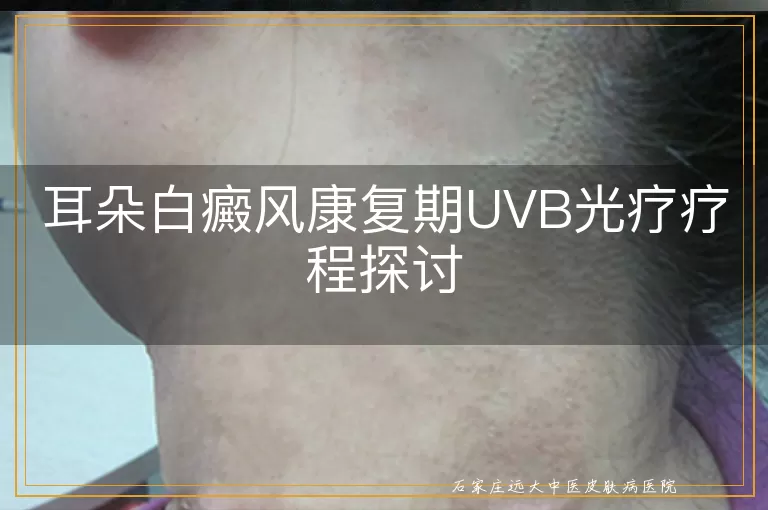 耳朵白癜风康复期UVB光疗疗程探讨