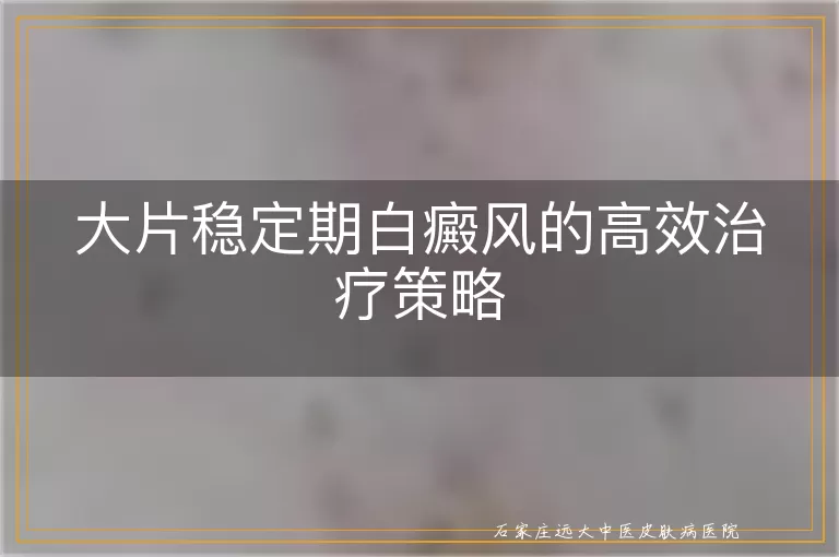 大片稳定期白癜风的高效治疗策略