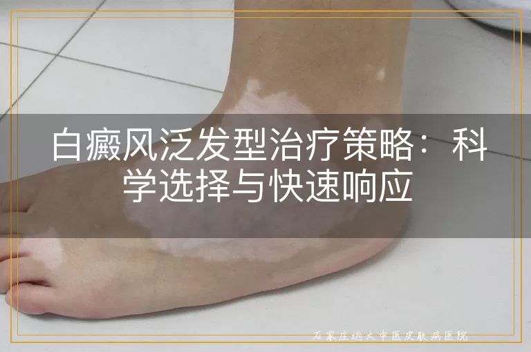 白癜风泛发型治疗策略：科学选择与快速响应