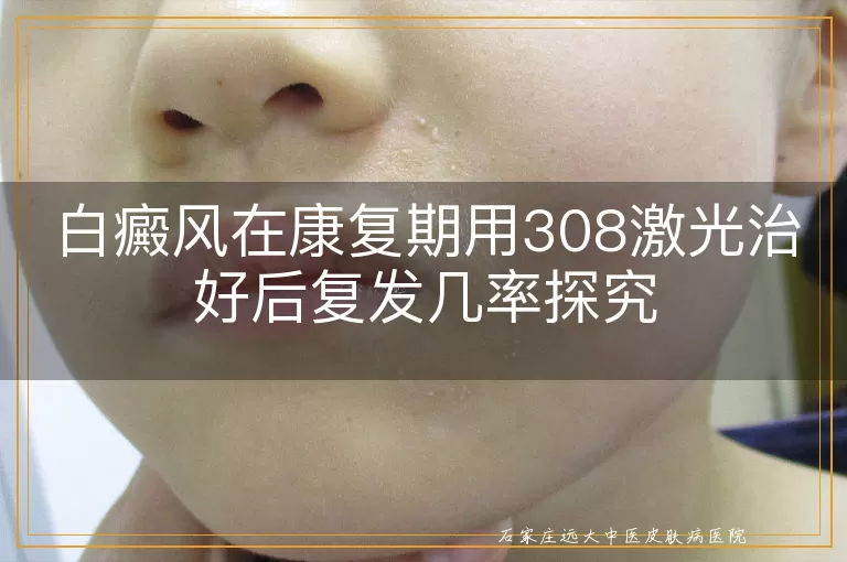 白癜风在康复期用308激光治好后复发几率探究