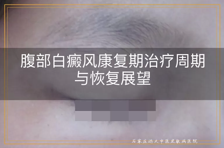 腹部白癜风康复期治疗周期与恢复展望