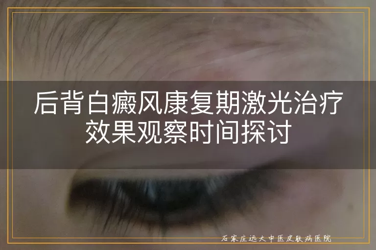 后背白癜风康复期激光治疗效果观察时间探讨