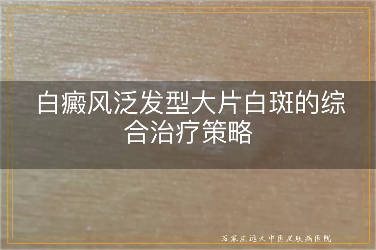 白癜风泛发型大片白斑的综合治疗策略