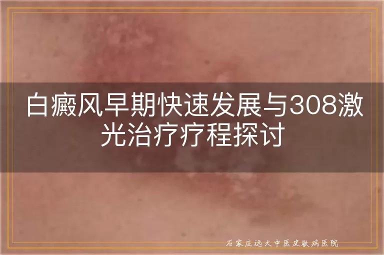 白癜风早期快速发展与308激光治疗疗程探讨