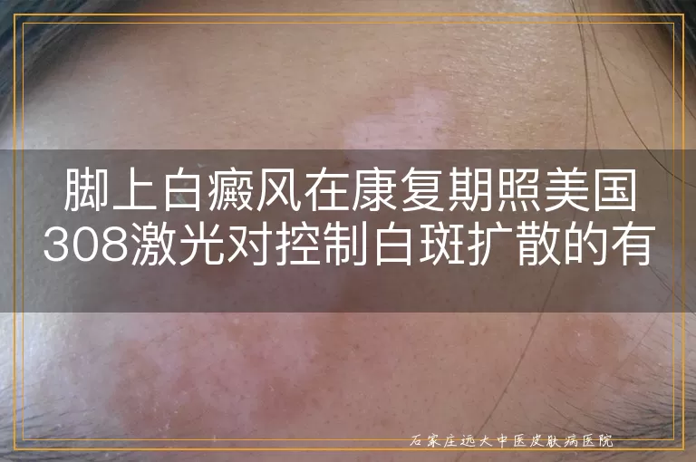 脚上白癜风在康复期照美国308激光对控制白斑扩散的有效性分析