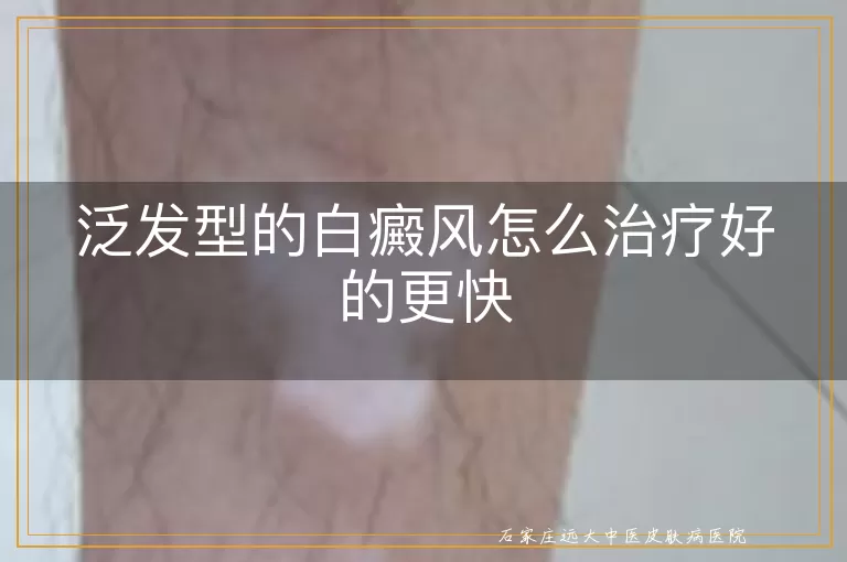 泛发型的白癜风怎么治疗好的更快